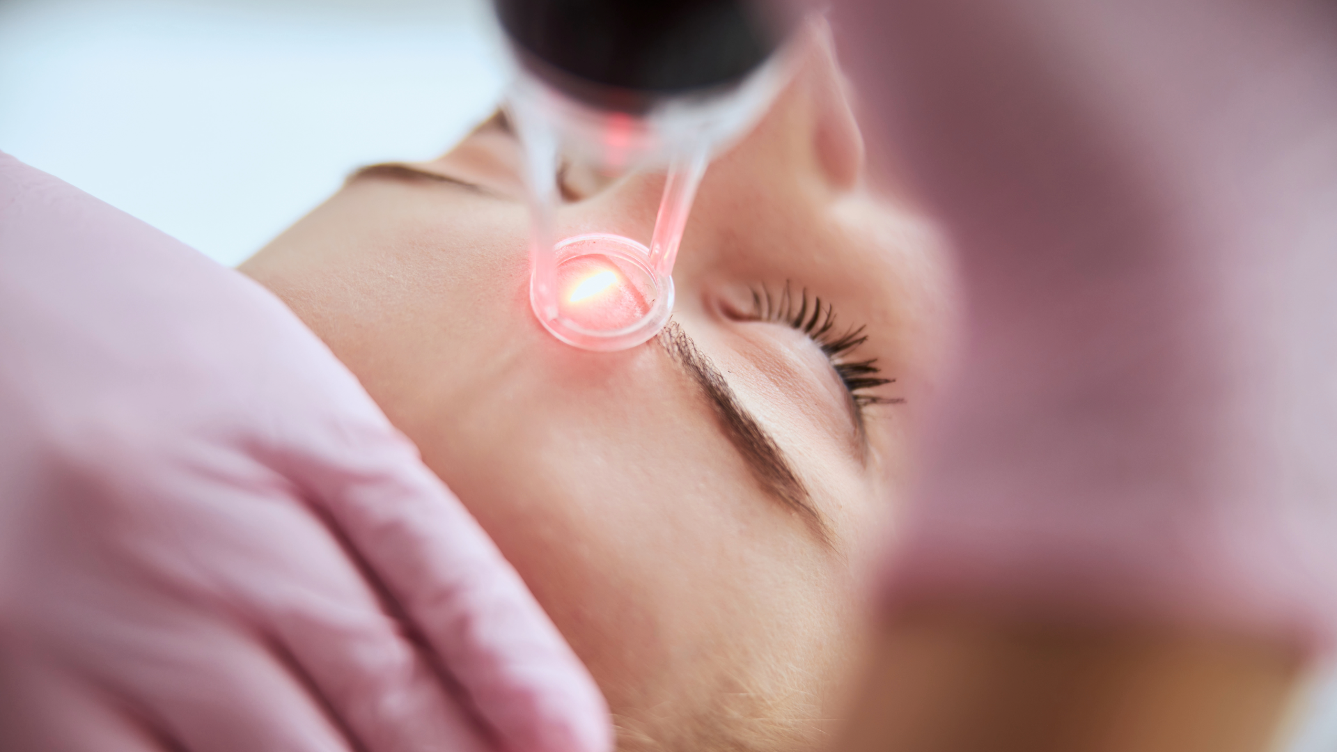 Sublative Radiofrequency Laser Skin Resurfacing Techniques